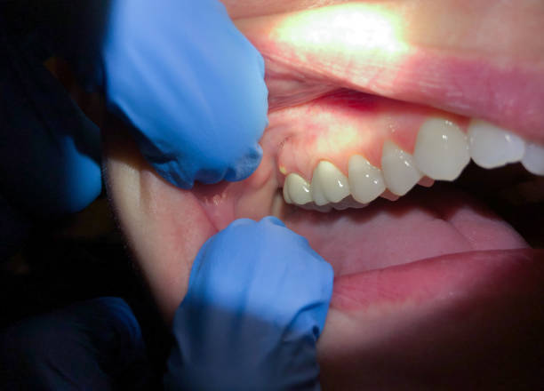 Emergency Dental Filling Replacement in AR